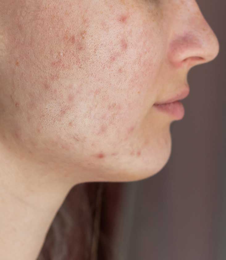 Beautybellbd | Best Skin Care Products Price in Bangladesh 13 rash-before